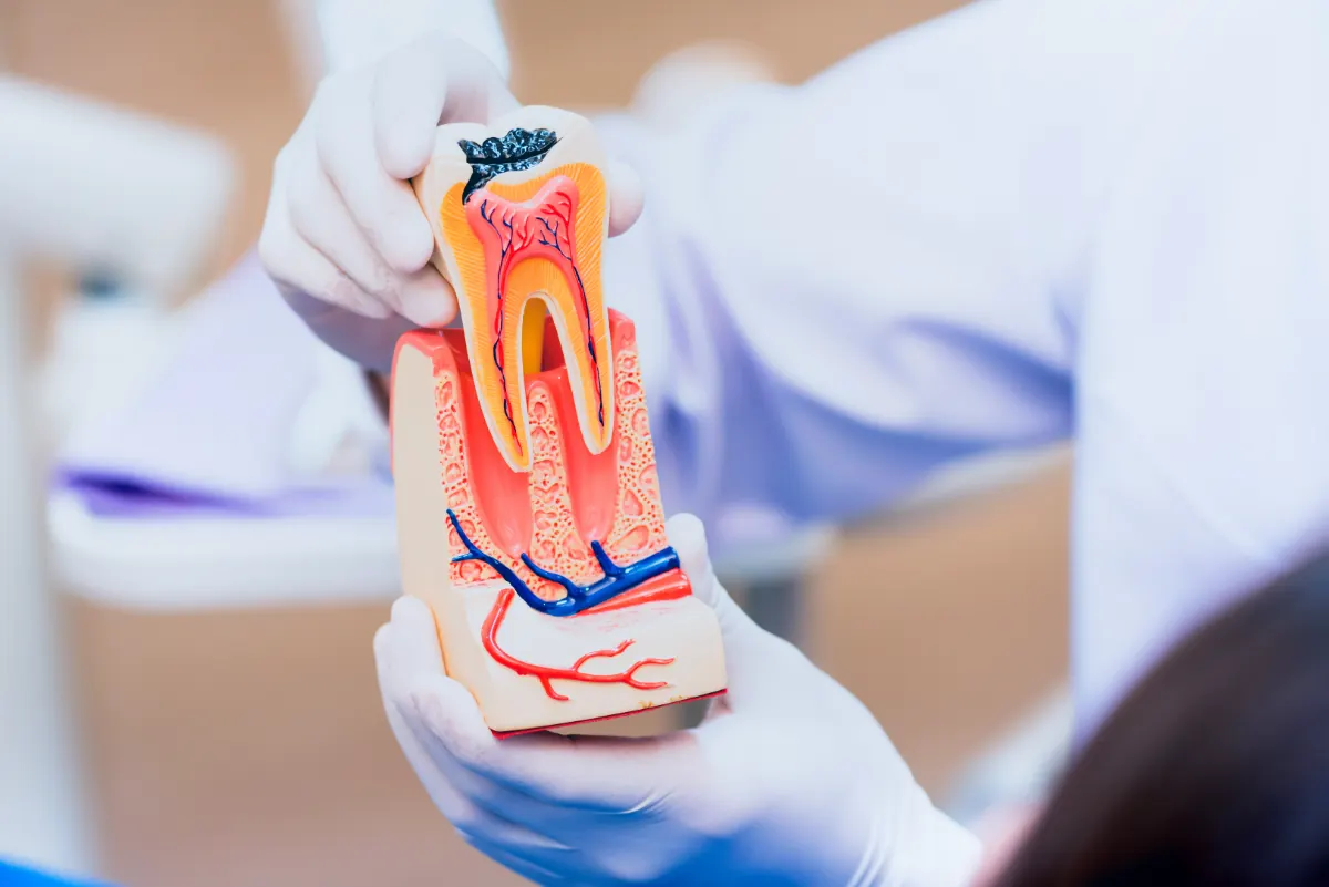 Modelo anatômico de dente com polpa e canais da raiz, usado para explicar o tratamento de canal