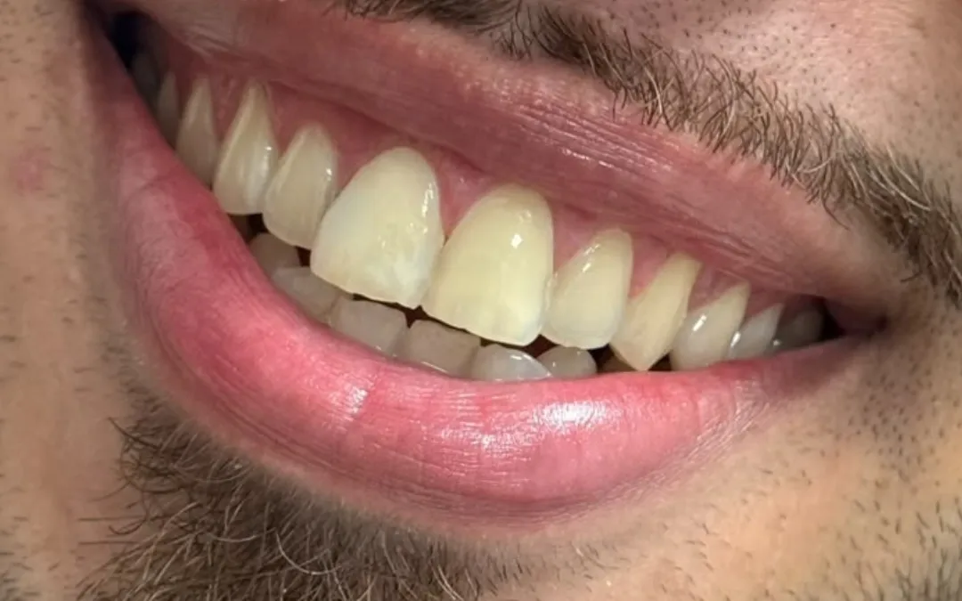 Antes do tratamento: dentes amarelados, com formatos irregulares e desalinhados