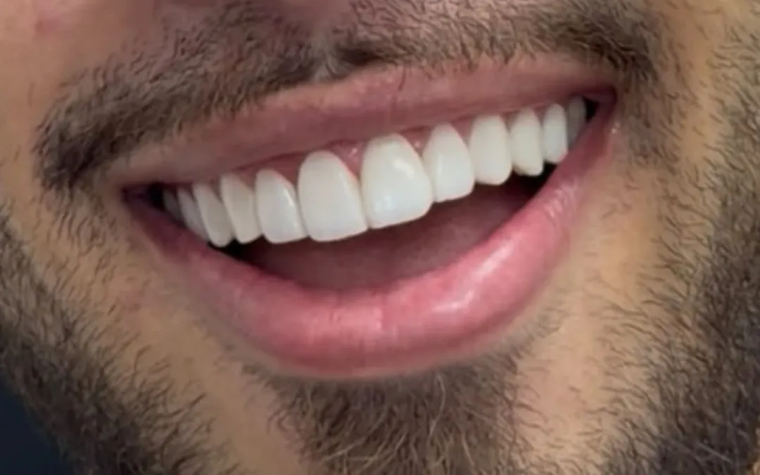 Depois das facetas: dentes claros, alinhados e com formato uniforme